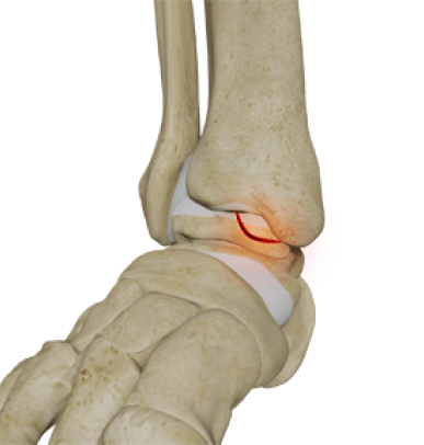 Osteochondral Injuries