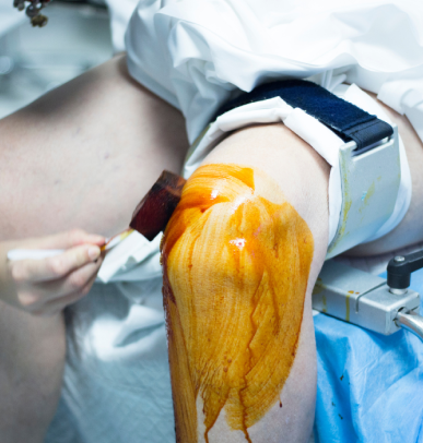 Synovectomy removes the inflamed synovium.