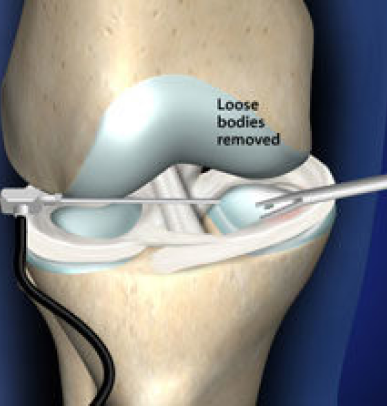 Arthroscopy to remove loose bodies in the knee joint