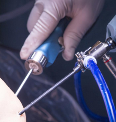 In some instances, arthroscopy is performed for diagnostic purposes. Here, the surgeon identifies the underlying knee injuries.