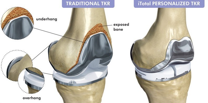 custom knee implants