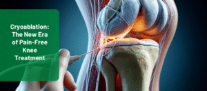Cryoablation for knee pain