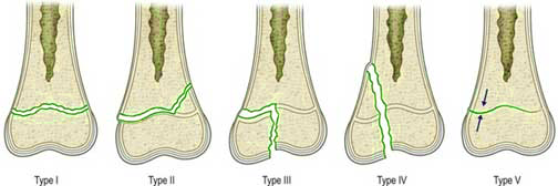 growth fracture
