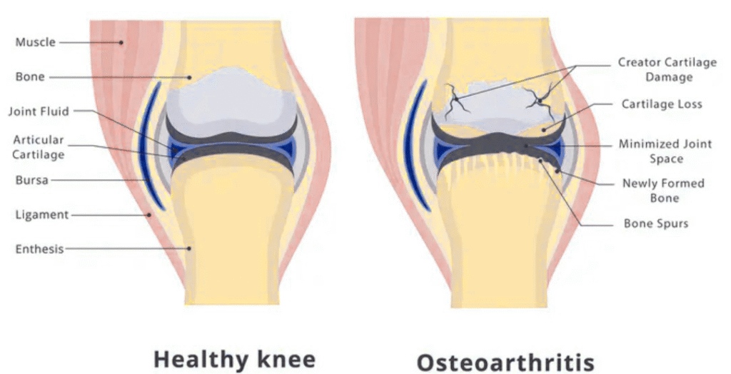 knee osteoarthritis