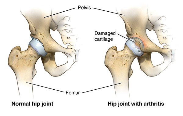 hip osteoarthritis