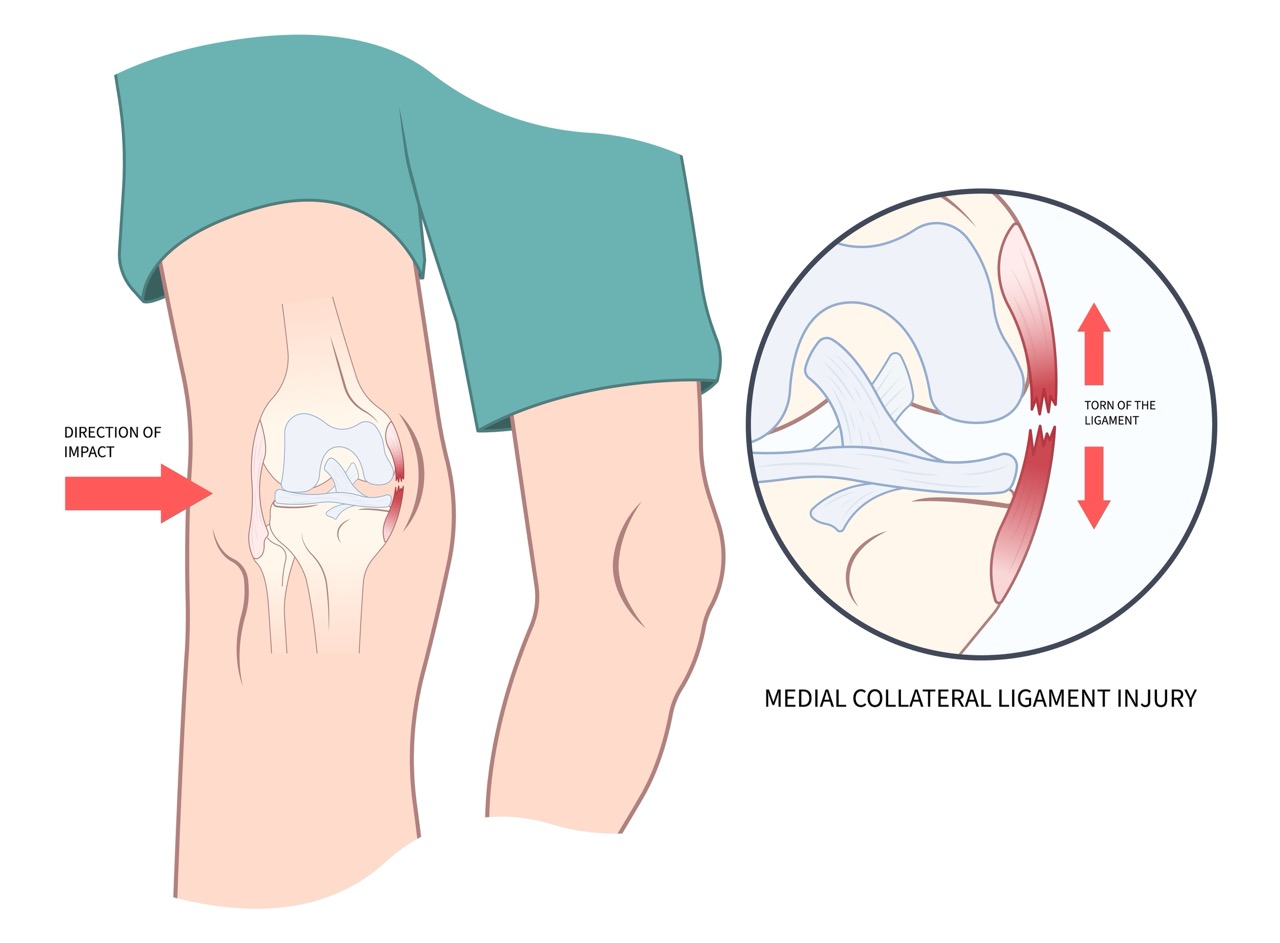 Knee Ligament Injuries Explained: Understanding ACL, PCL, MCL & LCL Tears