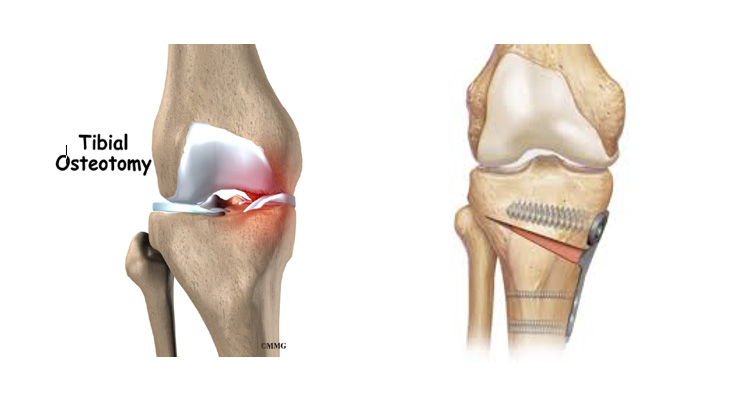 Knee Osteotomy in Dubai