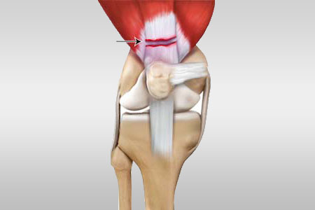 Quadriceps Tendon Repair in Dubai
