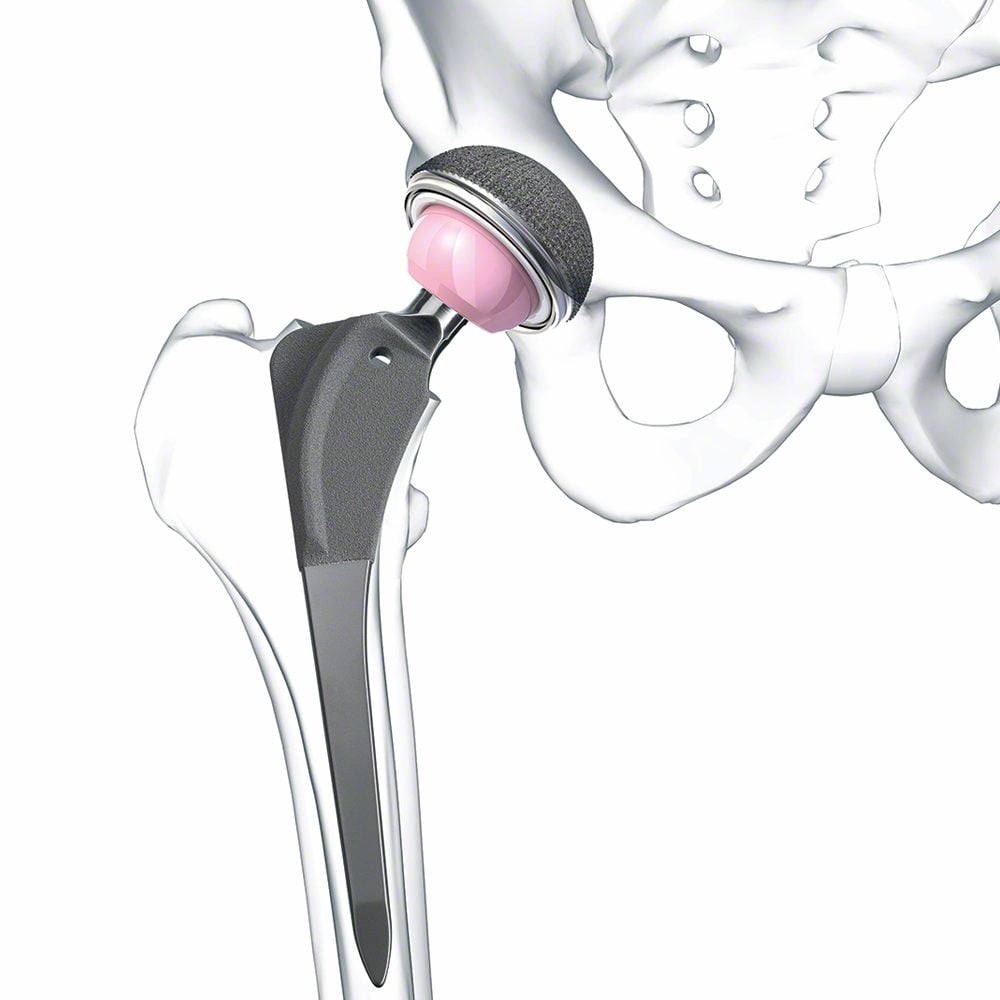 hip-arthroplasty