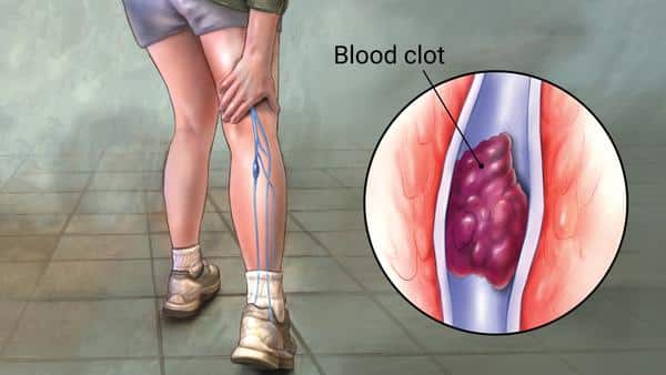 dvt after acl surgery