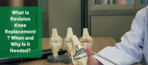 revision knee replacement
