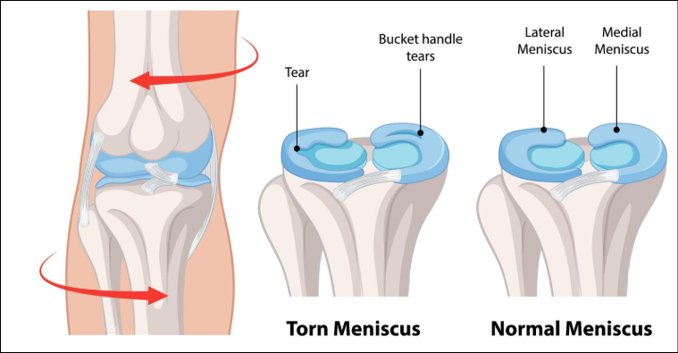 torn meniscus