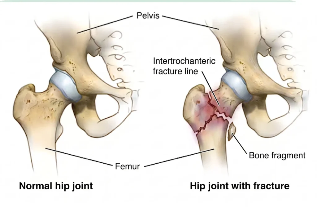 hip bone fracture